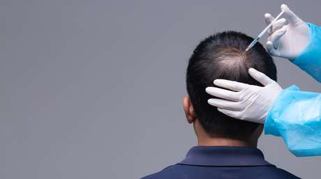 Hair loss is greater in men than in women