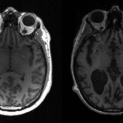 Alzheimer’s vaccine tested on humans in Finland – Science