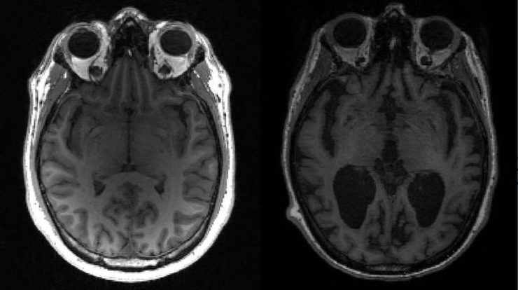 Alzheimer’s vaccine tested on humans in Finland – Science