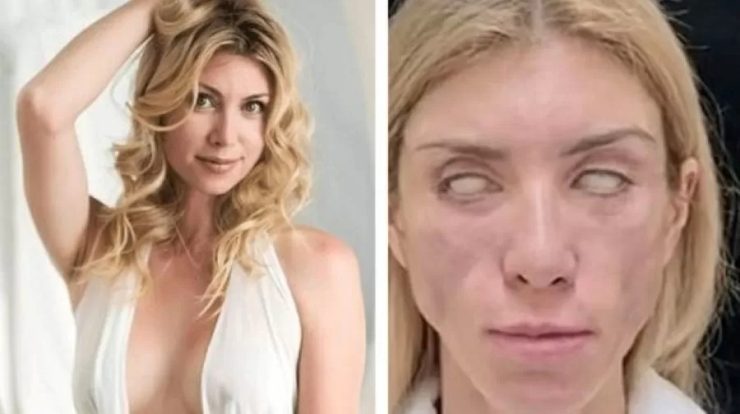 The R,000 plastic surgery goes wrong and leaves the ex-Russian girl without smiling or closing her eyes