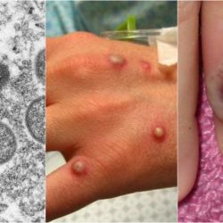 Symptoms that appear before skin blisters appear