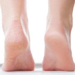 Symptoms of diabetes can start in the feet