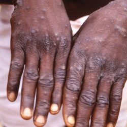 The government establishes a committee to monitor monkeypox cases