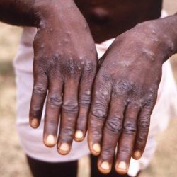 WHO says monkeypox poses ‘moderate risk’