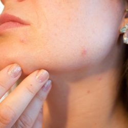 Why do pimples appear due to sweat and how can we prevent them?