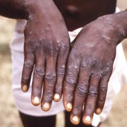 Urgent: Health confirms the first case of monkeypox in Acre