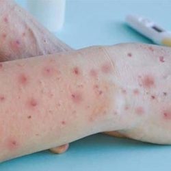 Four suspected monkeypox cases have been reported in Teresina, according to FMS