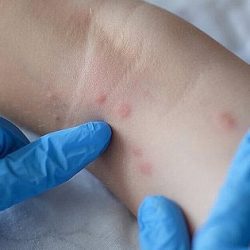 Salvador confirms another case of monkeypox;  The total number of cases in Bahia is 13