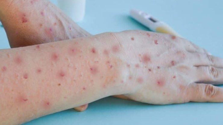 Brazil records more than 5,000 cases and 2 deaths from monkeypox