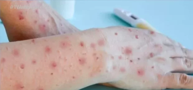 A case of monkeypox has been confirmed in southern Santa Catarina