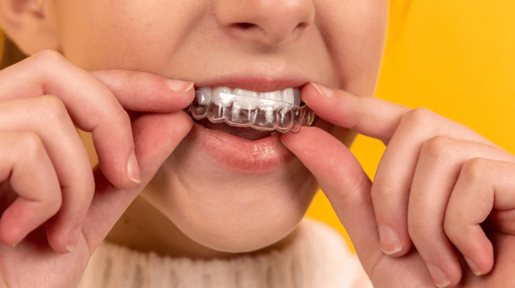 What are the types of dentals retainers?